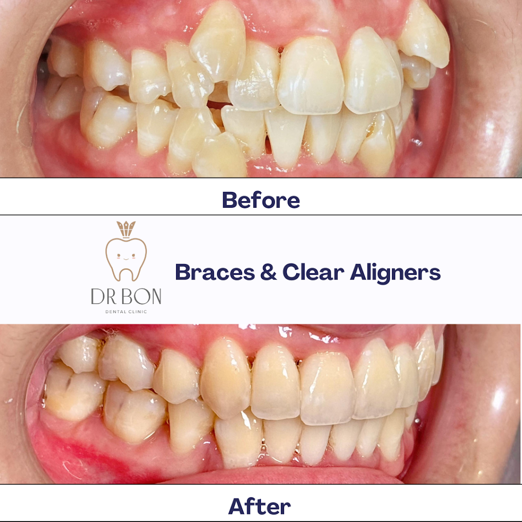 before and after